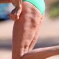 La celulitis de las famosas, �ellas tampoco se libran!