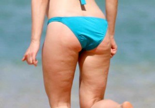 Celulitis: consejos de prevención y tratamiento para ¡acabar con ella!