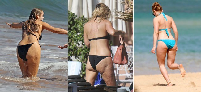Celulitis: consejos de prevenci�n y tratamiento para �acabar con ella!