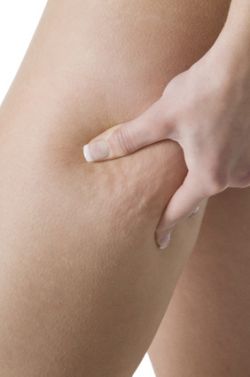 Combatir la celulitis con los �ltimos tratamientos