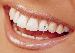 El Bling Bling, la última tendencia en joyería dental
