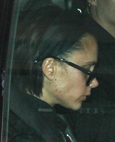 Foto Victoria Beckham sufre acné