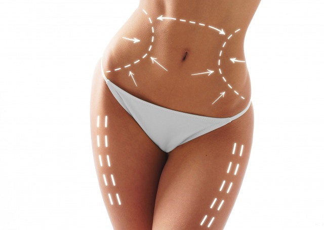 Foto Las 10 preguntas más frecuentes sobre la liposucción